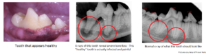 Tooth that appears healthy and x-rays of an infected versus a healthy tooth
